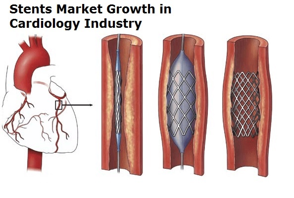 Stents Market'