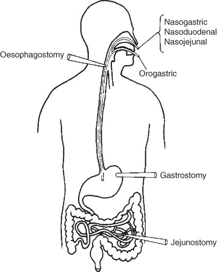 Nasogastric and Orogastric Tube Market is expected to reach