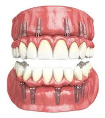 Full mouth dental implants