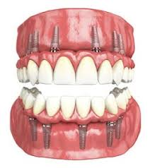 Full mouth dental implants'
