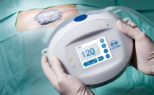 NPWT Devices Global Market to 2025&ndash; Acelity, Mlnly