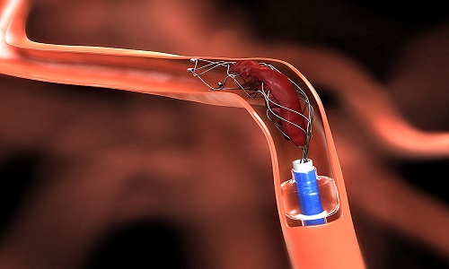 Neurovascular Stents'