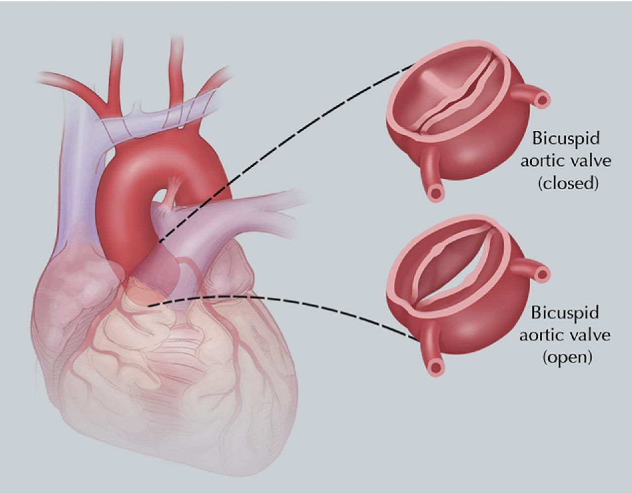 Aortic Valve Market