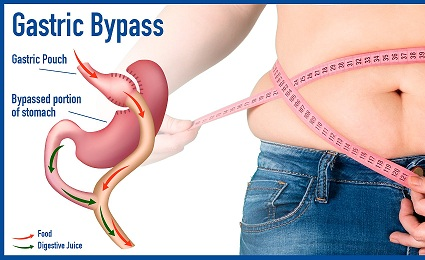 gastric Bypass  Market'