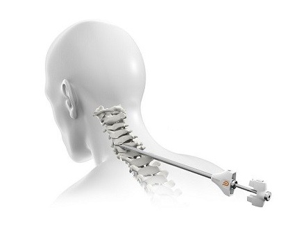 Cervical Fusion Market'