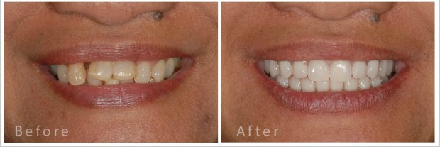all-on-4 dental implants