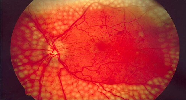 Diabetic-Retinopathy-Market