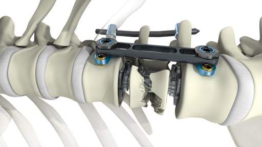 Thoracolumbar Spine Devices Market'