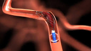 Global Neurovascular Devices Support Devices Market