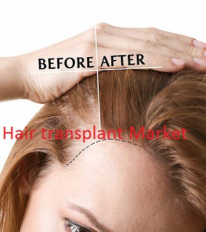 Hair transplant Market'