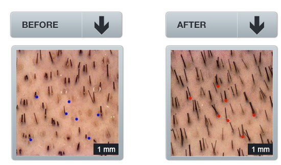 hair loss'