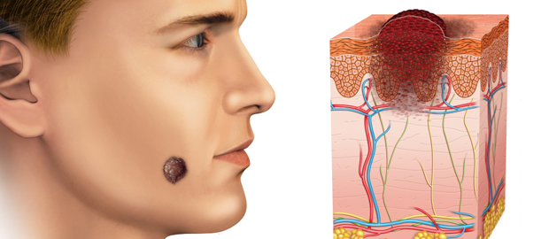Soft tissue sarcoma market