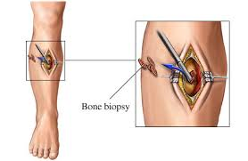 Bone Biopsy Market'