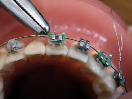 Global Digital Orthodontics Market