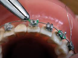 Global Digital Orthodontics Market'