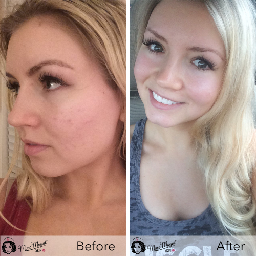 Minx Mogul Skin MD Results (Before and After)'