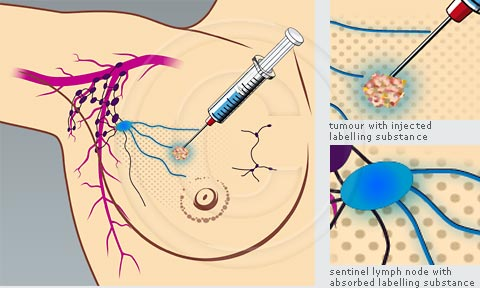 sentinel nod biopsy market'