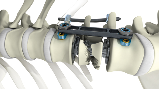 Thoracolumbar Spine Devices'