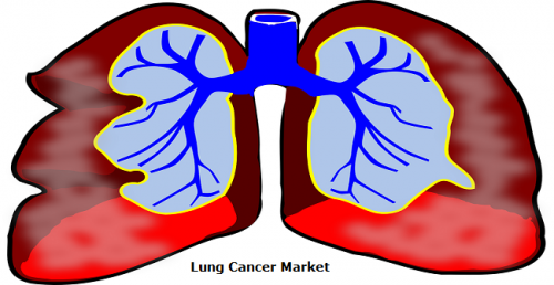 Lung Cancer Market Experiences an Enormous CAGR Growth'