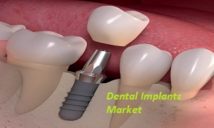 Dental Implants Market'