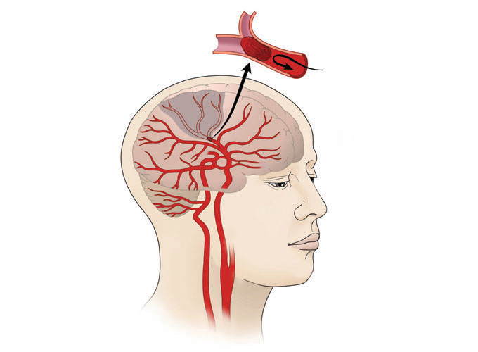 Ischemic Stroke Market'