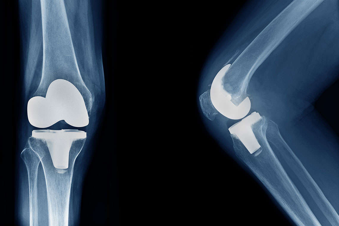 Knee Implants