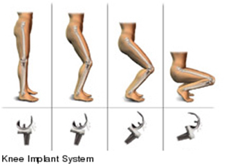 Knee Implants Industry'