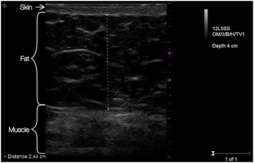 Ultrasound image of abdomen of a patient BEFORE truSculpt&am'