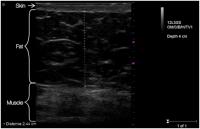 Ultrasound image of abdomen of a patient BEFORE truSculpt&am