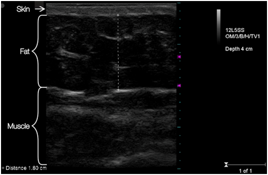 Same patient twelve weeks AFTER two treatments with truSculp'