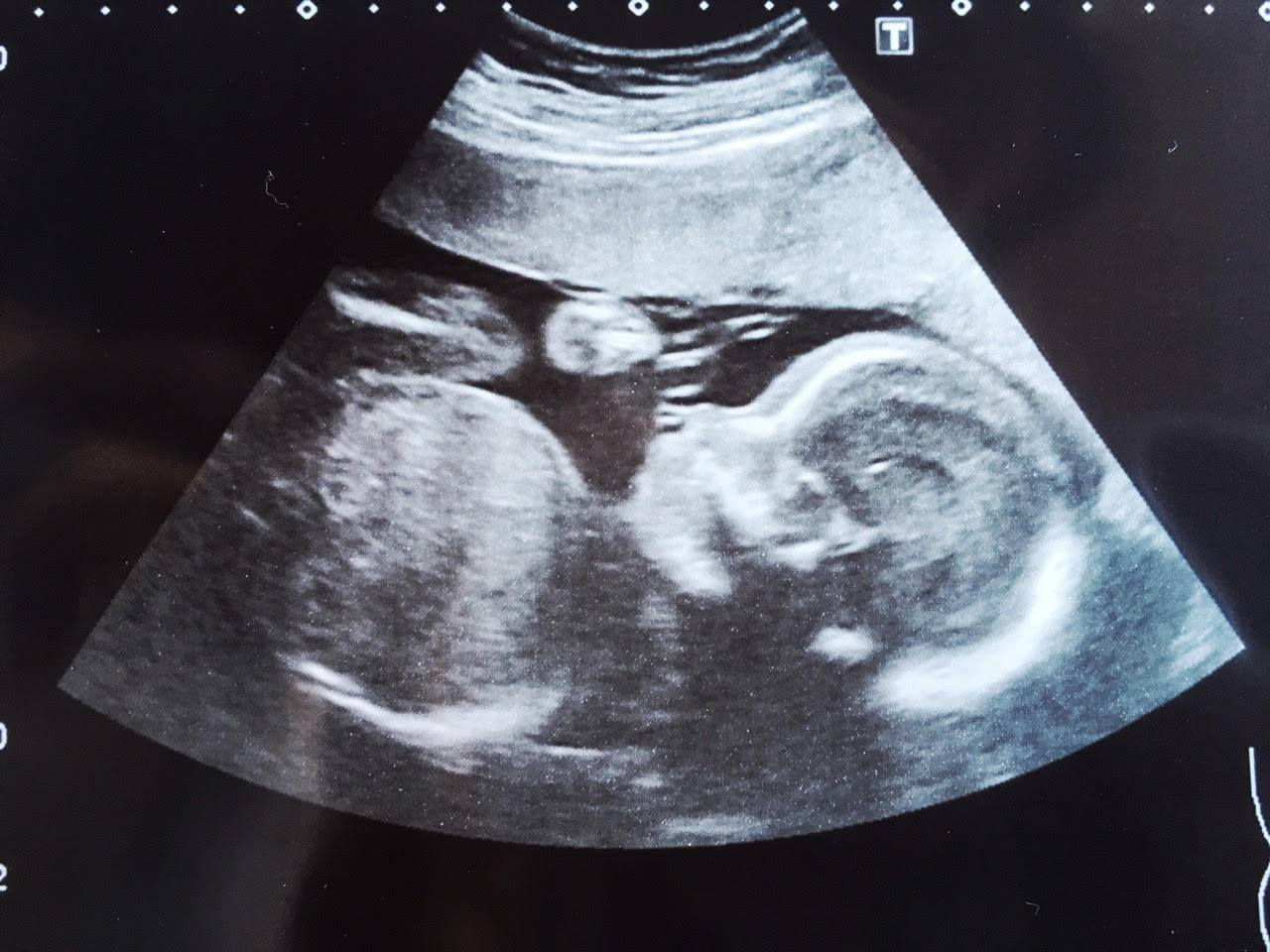 Reversal Of Vasectomy'