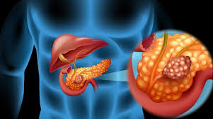 Pancreatic Cancer Therapeutics Market