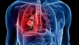 Lung Cancer Therapeutics Market'