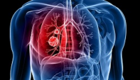Lung Cancer Therapeutics Market