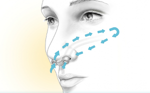 deviated septum surgery