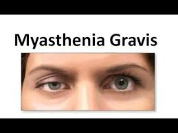 Myasthenia Gravis Market