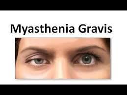 Myasthenia Gravis Market'