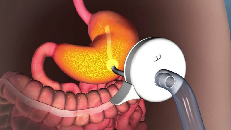 Global Weight Loss Stomach Pump Market'