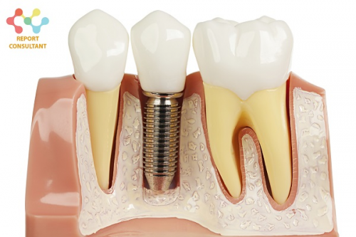 Dental Implants Market'