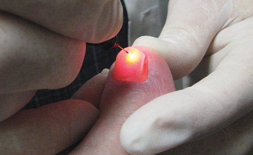 Toenail Fungus Treatment'