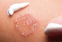 Skin Infection Market Analysis &amp; Forecast For Next 5