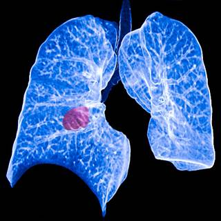 Drugs for Non-small Cell Lung Cancer Market'