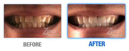 Zero peroxide'