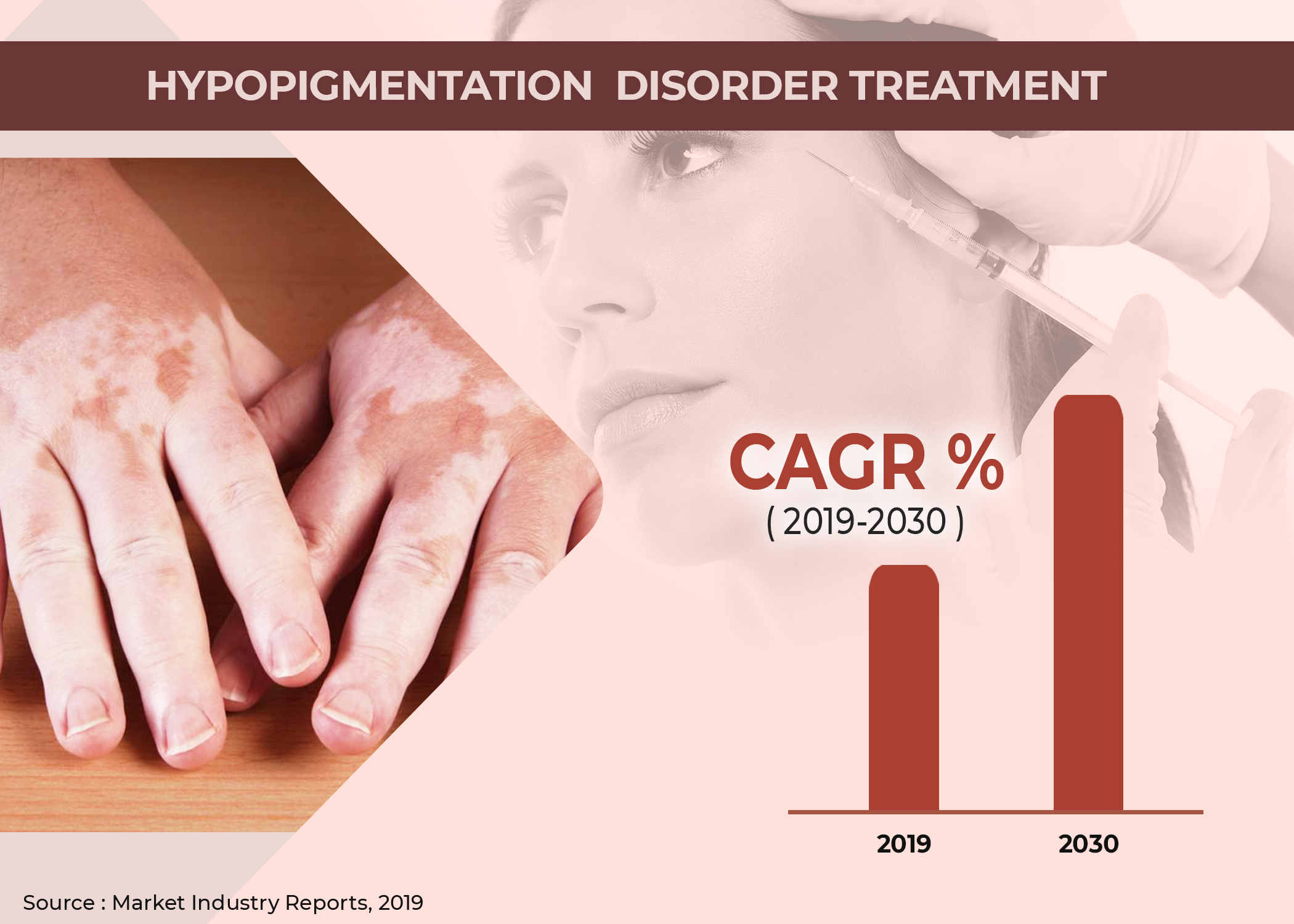 Hypopigmentation Disorders Treatment Market'