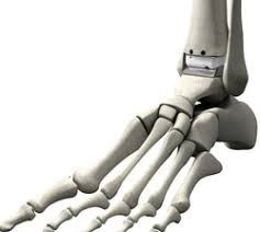 Ankle Replacement Market