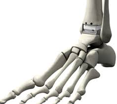 Ankle Replacement Market'