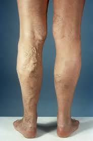 Global Varicose Veins Market'