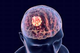 Brain Tumor Therapeutics Market'