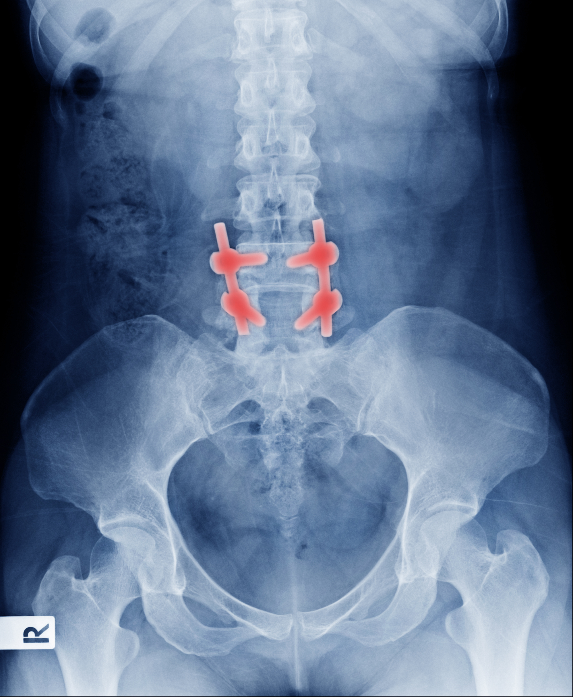 Dog Walkers Beware: Study Shows Bone Breaks on Rise Among Ol