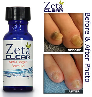 Zetaclear'